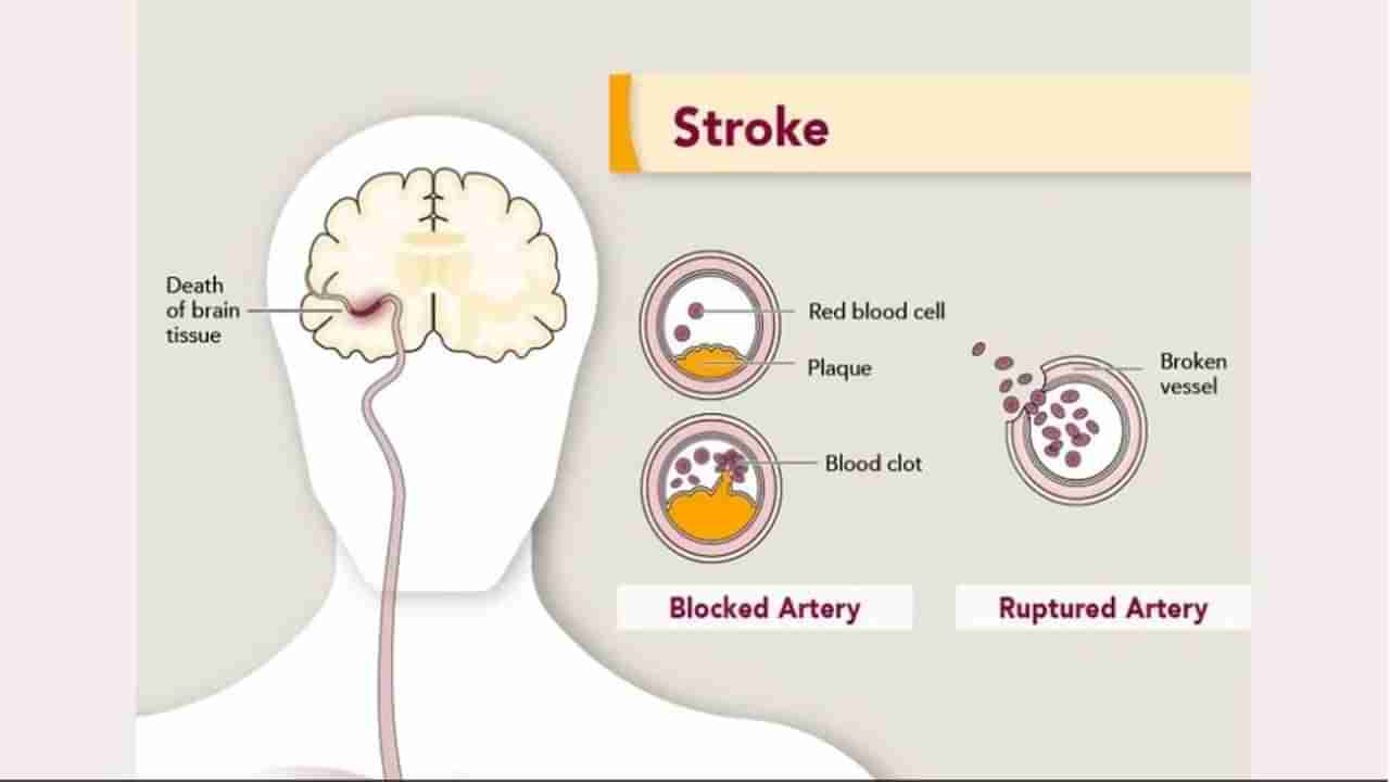 Brain Stroke: સ્ટ્રોક પહેલા શરીરમાં ડિપ્રેશનના લક્ષણો દેખાવા લાગે છે