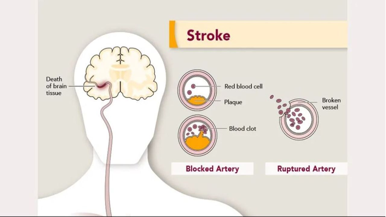 Brain Stroke: સ્ટ્રોક પહેલા શરીરમાં ડિપ્રેશનના લક્ષણો દેખાવા લાગે છે