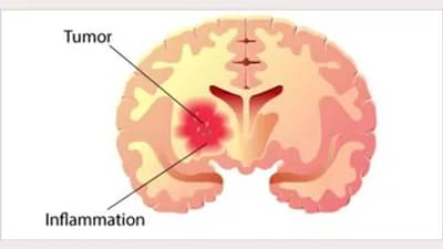 World Brain Day 2022 : બ્રેઈન ટ્યુમર હોય ત્યારે જોવા મળે છે આ 26 લક્ષણો, જાણો ડોક્ટરો પાસેથી બચવાના ઉપાયો