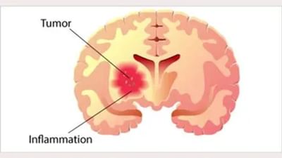 World Brain Day 2022 : બ્રેઈન ટ્યુમર હોય ત્યારે જોવા મળે છે આ 26 લક્ષણો, જાણો ડોક્ટરો પાસેથી બચવાના ઉપાયો