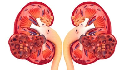 Kidney Health : વારંવાર થતા વાયરલ ઇન્ફેક્શનની અસર કેવી રીતે થાય છે કિડનીના સ્વાસ્થ્ય પર, જાણો