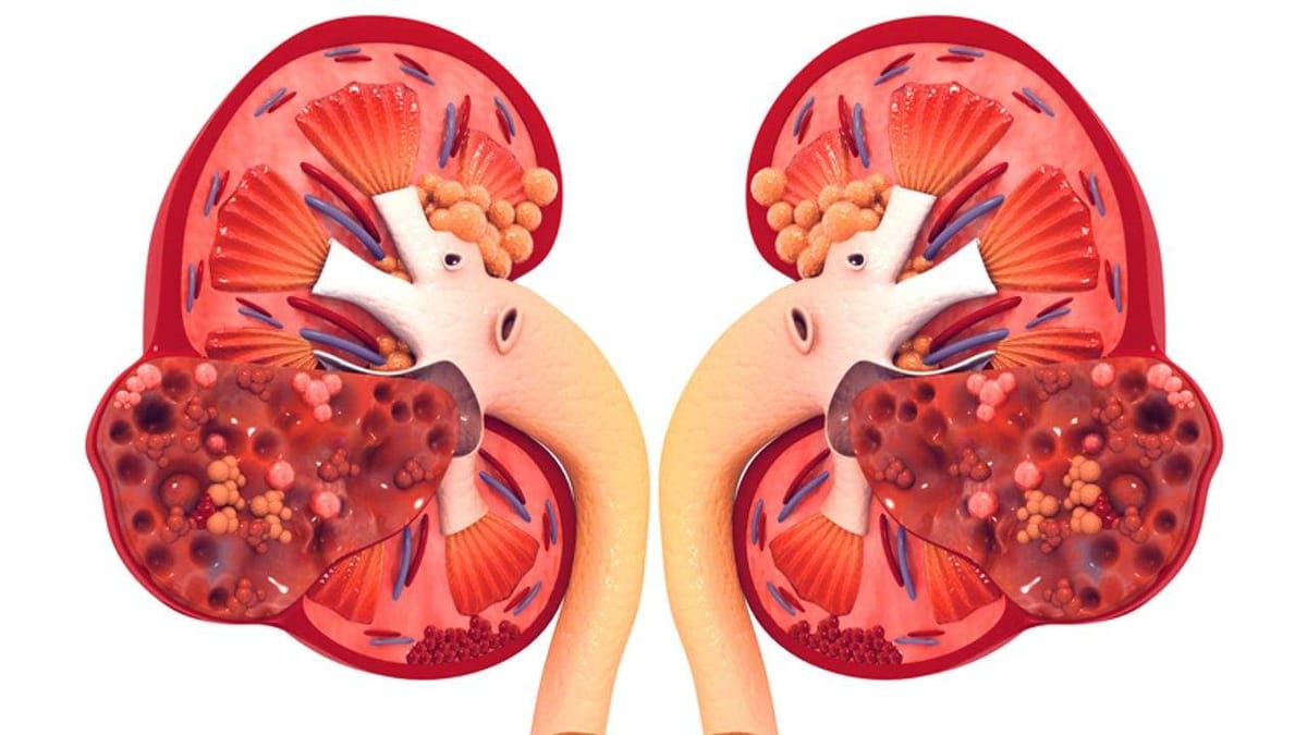 Kidney Health : વારંવાર થતા વાયરલ ઇન્ફેક્શનની અસર કેવી રીતે થાય છે કિડનીના સ્વાસ્થ્ય પર, જાણો