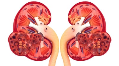 Kidney Health : વારંવાર થતા વાયરલ ઇન્ફેક્શનની અસર કેવી રીતે થાય છે કિડનીના સ્વાસ્થ્ય પર, જાણો