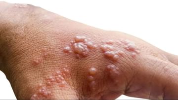 Monkeypox Diet : મંકીપોક્સથી બચવા માટે, આહારમાં આ વસ્તુઓનો સમાવેશ કરો, તમે ઝડપથી સ્વસ્થ થઈ શકશો !