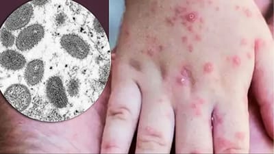 મંકીપોક્સના વધતા ખતરાને જોતા કેન્દ્ર સરકાર એલર્ટ, રસી બનાવતી કંપનીઓ માટે ટેન્ડર બહાર પડાયા