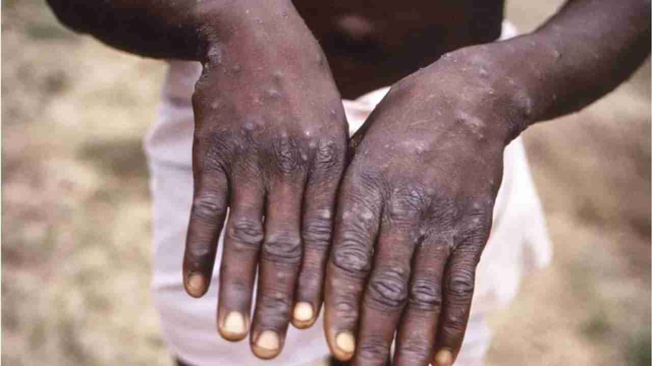 Monkeypox:  મંકીપોક્સના કારણે ત્રણ સંક્રમિતોના મોત થયા, WHOએ કહ્યું- બધા દેશો સાવધાન રહો