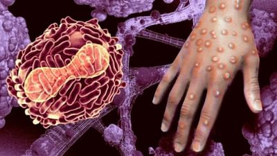 Monkeypox: કેરળ, દિલ્હી બાદ હવે બિહારમાં મંકીપોક્સની દસ્તક! પટનામાં શંકાસ્પદ કેસ સામે આવ્યો