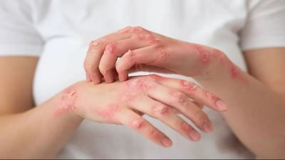 Psoriasis : સોરાયસીસ જેવી ત્વચાની સમસ્યા દૂર થઈ જશે, બસ આ આયુર્વેદિક ટિપ્સ અનુસરો