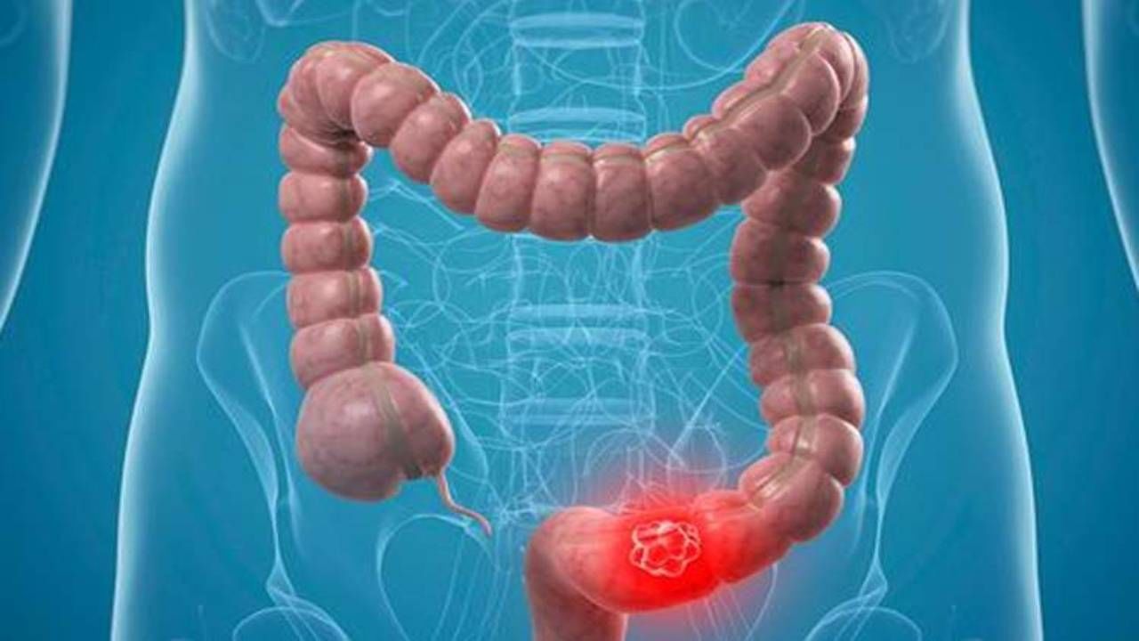 Intestine Cancer : પેટમાં દુખાવો અને ડાયેરીયા, નાના આંતરડાના કેન્સરના આવા હોય શકે છે લક્ષણો, જાણો
