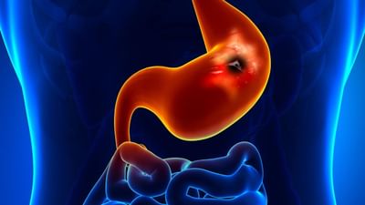 Stomach Ulcer : જો પેટમાં દુખાવો કે આ બીજા લક્ષણો અનુભવાય તો હોય શકે છે પેટનું અલ્સર