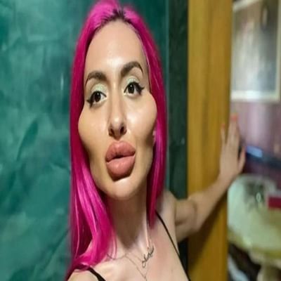 યૂક્રેનની એક 33 વર્ષની મોડેલ એનાસ્તાસિયા પોક્રેશચુકએ પોતાના ગાલ પર ઘણીવાર પ્લાસ્ટિક સર્જરી કરાવી છે, જેના કારણે તેના ગાલનો ભાગ વધી ગયો છે.