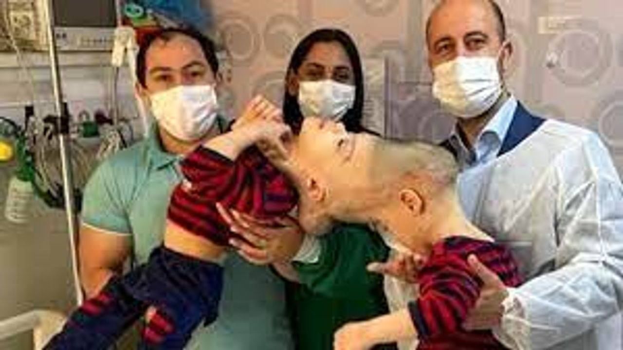 Trending News : વિશ્વનું સૌથી જટિલ ઓપરેશન, માથેથી જોડાયેલાં 2 બાળકોને અલગ કરવા વિવિધ દેશના ડોક્ટરોએ રાત દિવસ કર્યા એક