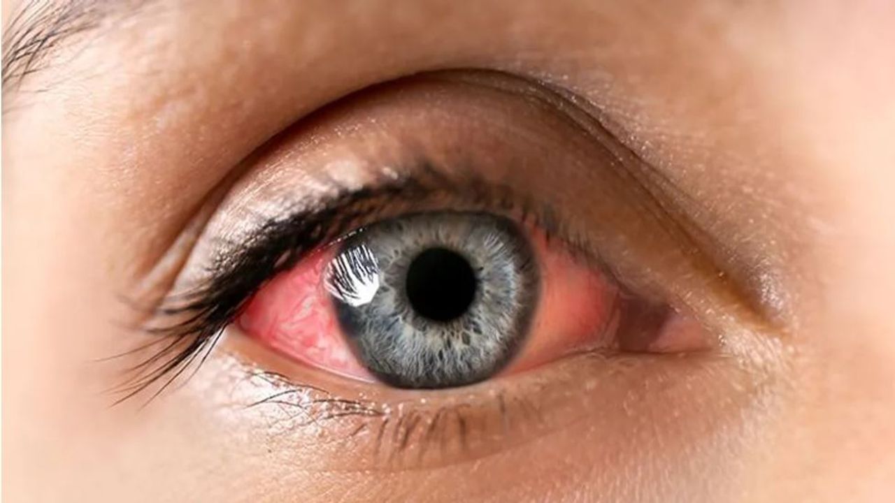 Eye Diseases: ટાઇપ-2 ડાયાબિટીસ આંખોને નુકસાન પહોંચાડી શકે છે, ગ્લુકોમાનું જોખમ છે