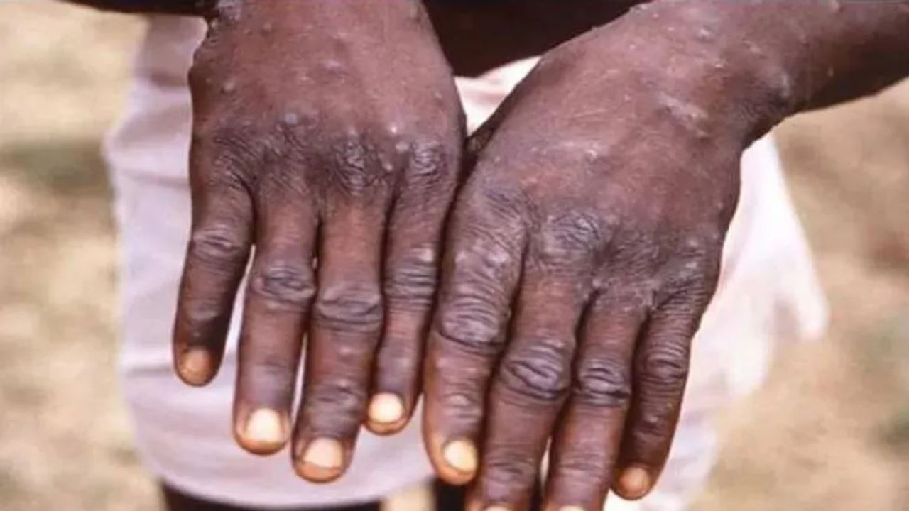 monkeypox: આ વાયરસ ઘણા અઠવાડિયા પછી સ્વસ્થ થયા પછી પણ શરીરમાં હોઈ શકે છે
