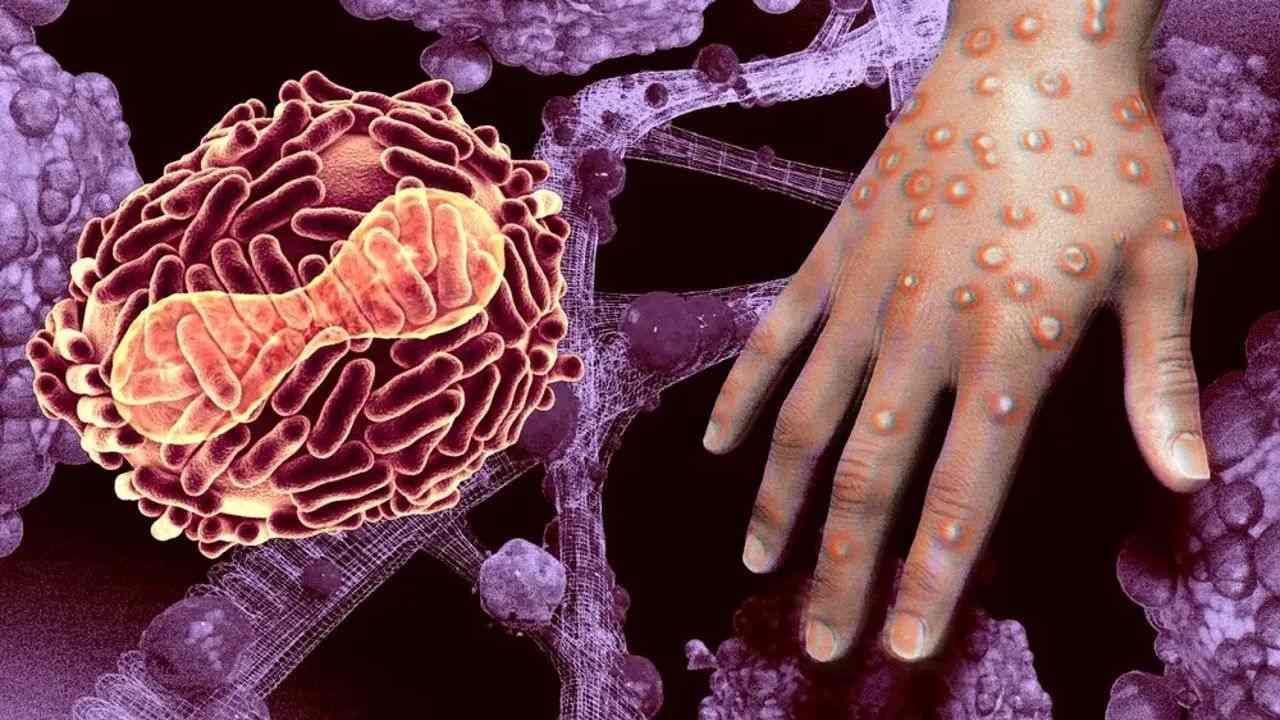 Monkeypox Virus: કોરોના વાયરસથી ગંભીર રીતે બીમાર લોકો માટે મંકીપોક્સનો ખતરો વધારે રહેશે ?