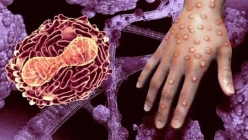 Monkeypox Virus: કોરોના વાયરસથી ગંભીર રીતે બીમાર લોકો માટે મંકીપોક્સનો ખતરો વધારે રહેશે ?