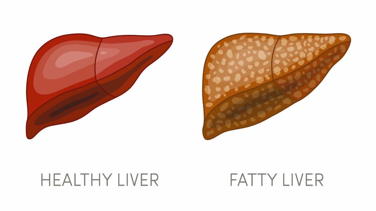 Fatty Liver: ફેટી લીવરની સમસ્યામાં કયા ખોરાકનું કરશો સેવન?