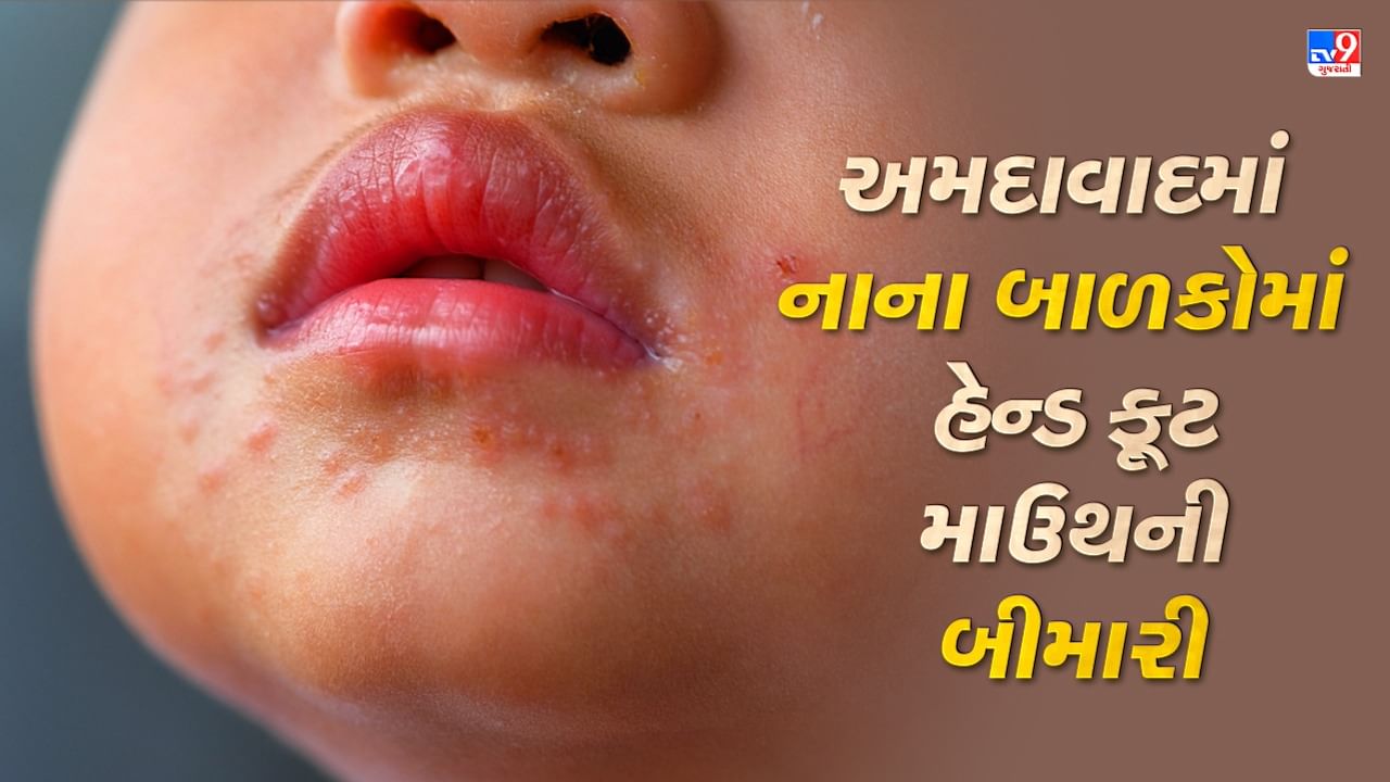 Ahmedabad: નાના બાળકોમાં હેન્ડ ફૂટ માઉથ બીમારીમાં વધારો, વાલીઓને સાવચેત રહેવા તબીબોની અપીલ