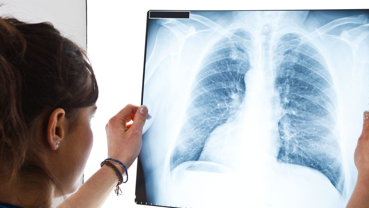 Lungs Cancer : સિગારેટ ન પીનાર લોકોને પણ થઇ શકે છે ફેફસાનું કેન્સર, જાણો શું હોઈ શકે કારણ