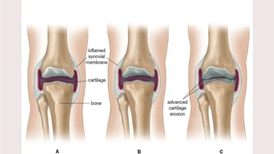 World Physiotherapy Day: શરીરમાં આ લક્ષણો ઓસ્ટિઓઆર્થરાઈટિસની નિશાની છે, કેવી રીતે રક્ષણ કરવું