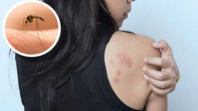 મચ્છર કરડવાથી ખંજવાળ કેમ આવે છે ખબર છે? વાંચો શું છે કારણ