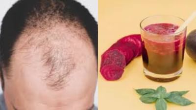 ટાલ પડવાની સમસ્યાનો ઈલાજ છે બીટરૂટ, આ રીતે ઘરે જ તૈયાર કરો હેર પેક