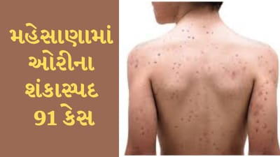 Mehsana : વડનગરના મોલીપુરમાં 12 વર્ષ સુધીના બાળકોમાં દેખાયા ઓરીના લક્ષણો, શંકાસ્પદ 91 કેસ મળી આવ્યા Mehsana : વડનગરના મોલીપુરમાં 12 વર્ષ સુધીના બાળકોમાં દેખાયા ઓરીના લક્ષણો, શંકાસ્પદ 91 કેસ મળી આવ્યા