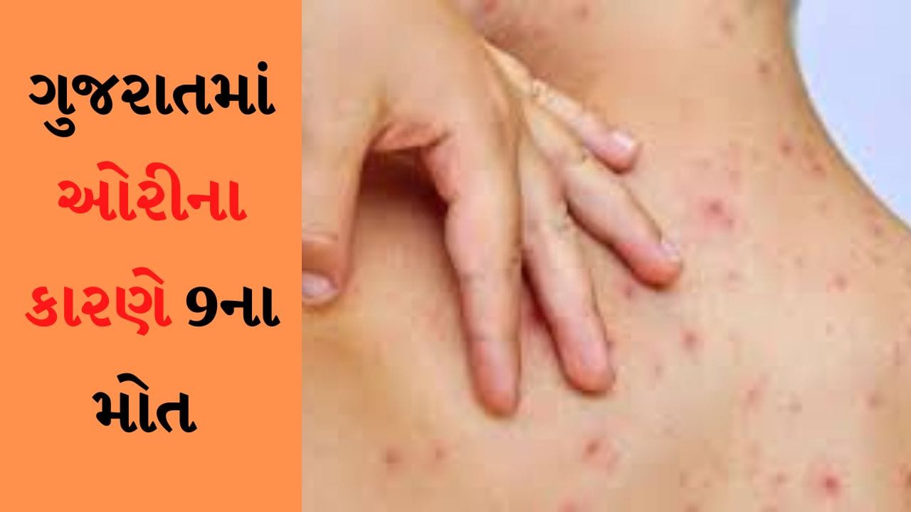 દેશમાં ઓરીના કારણે મોત મામલે ગુજરાત બીજા નંબરે, લોકસભામાં રજૂ કરાયા ઓરીના કેસ અને મોતના આંકડા