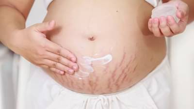 ગર્ભાવસ્થા પછી Stretch Marks થી ચિંતિત છો ? તો અજમાવો આ ઘરેલું ઉપાય, ચોક્કસ મળશે ફાયદો