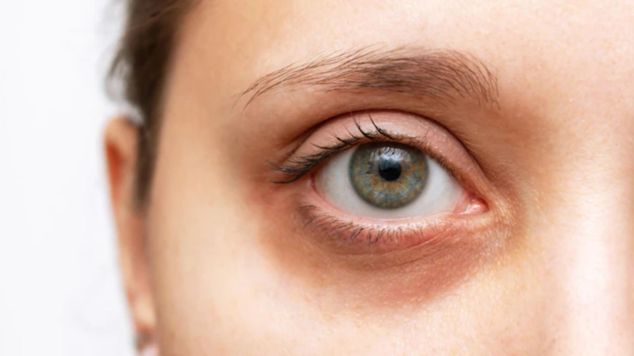 Eye Health Tips: આંખોની નીચે ડાર્ક સર્કલ સુંદરતા બગાડી શકે છે, ખોરાકમાં સામેલ કરો આ વસ્તુ અને મેળવો સમસ્યાથી છુટકારો