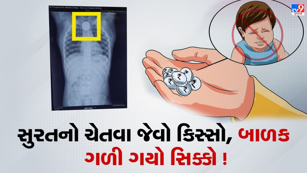 Surat : માતા-પિતા માટે ચેતવણી રૂપ કિસ્સો ! 3 વર્ષના બાળકના ગળામા ફસાયો સિક્કો, કરવી પડી સર્જરી