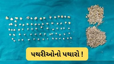 ચેન્નાઈની મહિલાના શરીરમાંથી નિકળી 1,200થી વધુ પથરી, ડોક્ટર પણ ચોંકી ગયા !!