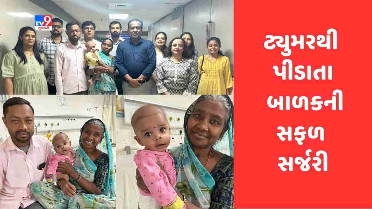 Ahmedabad: સિવિલ હોસ્પિટલના તબીબોને 5 મહિનાના બાળકના જડબાના ટ્યુમરની જટીલ સર્જરીમાં મળી સફળતા, 95 ટકા મોં માં ફેલાયેલુ હતુ ટ્યુમર