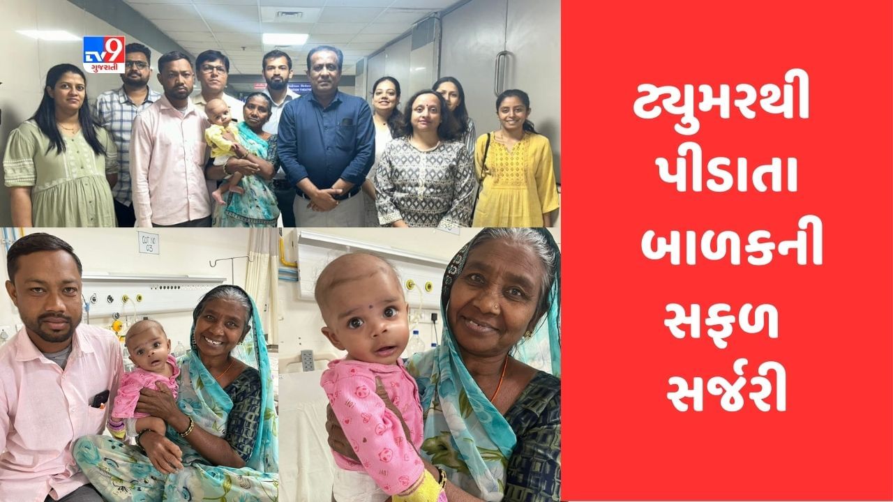 Ahmedabad: સિવિલ હોસ્પિટલના તબીબોને 5 મહિનાના બાળકના જડબાના ટ્યુમરની જટીલ સર્જરીમાં મળી સફળતા, 95 ટકા મોં માં ફેલાયેલુ હતુ ટ્યુમર