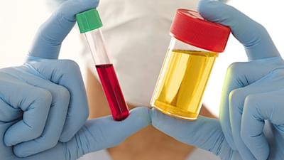 Blood In Urine : પેશાબમાં આવતું લોહી ખતરનાક રોગોની નિશાની છે, તરત જ કરાવો સારવાર