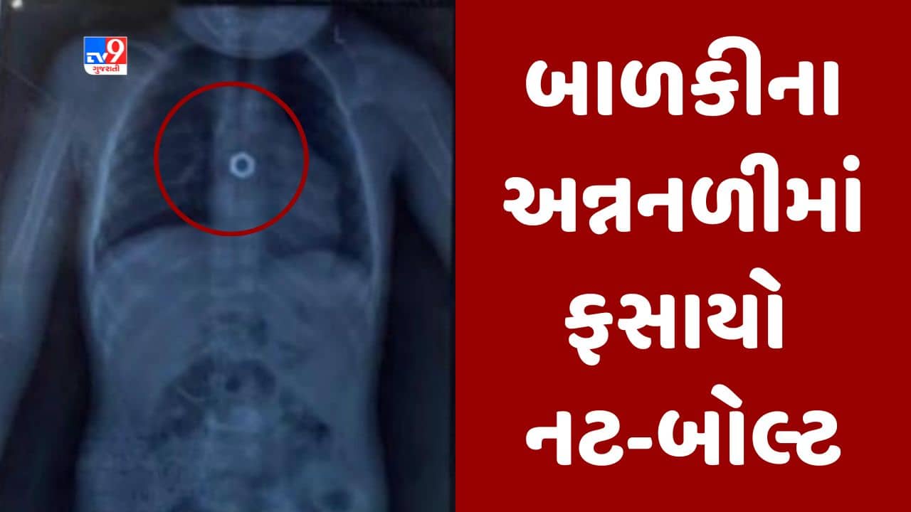 Surat: માતા-પિતા માટે ચેતવણી રૂપ કિસ્સો! 4 વર્ષના બાળકની અન્નનળીમાં ફસાયો નટ બોલ્ટ, જુઓ Video