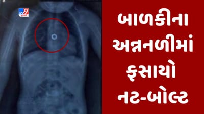 Surat: માતા-પિતા માટે ચેતવણી રૂપ કિસ્સો! 4 વર્ષના બાળકની અન્નનળીમાં ફસાયો નટ બોલ્ટ, જુઓ Video Surat: માતા-પિતા માટે ચેતવણી રૂપ કિસ્સો! 4 વર્ષના બાળકની અન્નનળીમાં ફસાયો નટ બોલ્ટ, જુઓ Video