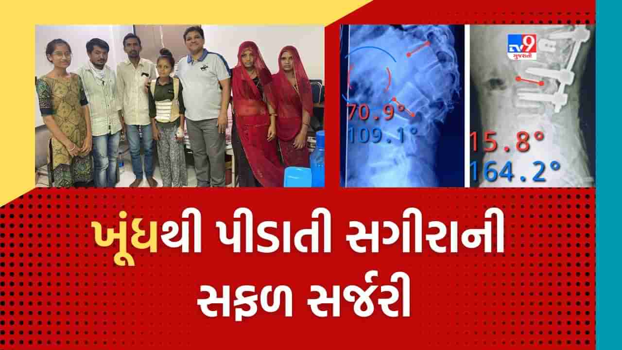 Ahmedabad: જન્મજાત ખૂંધની બિમારીથી પીડાતી સગીરાને ખૂંધની તકલીફમાંથી 15 વર્ષે મળી મુક્તિ, સિવિલના સર્જને પાર પાડી જટીલ સર્જરી