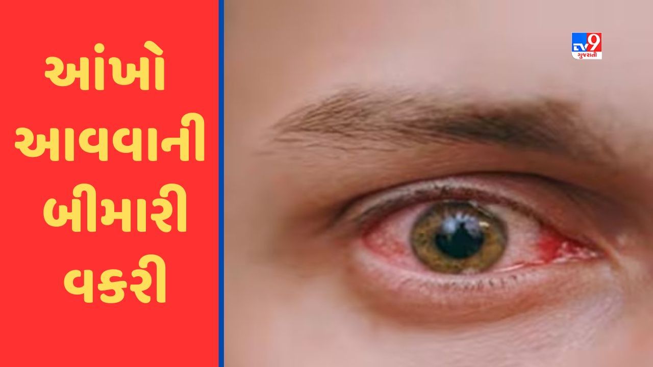 Ahmedabad: શહેરમાં ચોમાસામાં આંખો આવવાની બીમારી વકરી, સિવિલમાં રોજના 190 થી વધુ કેસો