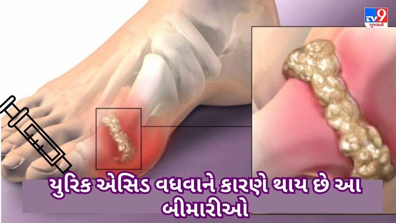 High Uric Acid: શરીરમાં યુરિક એસિડ વધવાને કારણે થાય છે આ બીમારીઓ, આ વસ્તુઓ સેવન કરવાનું ટાળો