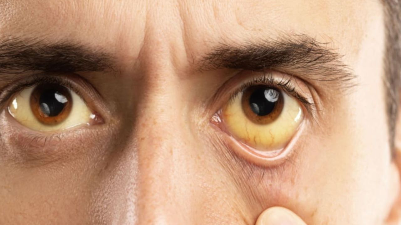 Jaundice Remedy આ 5 ઔષધીય પાંદડા કમળાને જડમૂળથી કરશે દૂર, લીવર પણ રહેશે મજબૂત Gujarati News