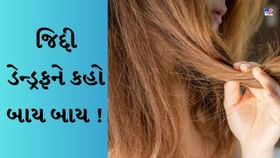 Dandruff Remedies : ડેન્ડ્રફની સમસ્યાથી પરેશાન છો તો અપનાવો આ રીત Dandruff Remedies : ડેન્ડ્રફની સમસ્યાથી પરેશાન છો તો અપનાવો આ રીત