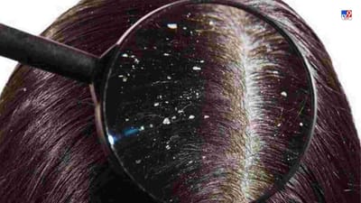 ઘણા લોકો ડેન્ડ્રફના કારણે પરેશાન રહે છે. કેટલીકવાર હઠીલા ડેન્ડ્રફને દૂર કરવું ખૂબ મુશ્કેલ છે. આવી સ્થિતિમાં ડેન્ડ્રફની સમસ્યાથી બચવા માટે તમે કેટલીક કુદરતી વસ્તુઓનો પણ ઉપયોગ કરી શકો છો. આ કુદરતી વસ્તુઓ ડેન્ડ્રફને તેના મૂળમાંથી દૂર કરે છે. આ સાથે તમારા વાળને અન્ય ફાયદાઓ પણ મળે છે.
