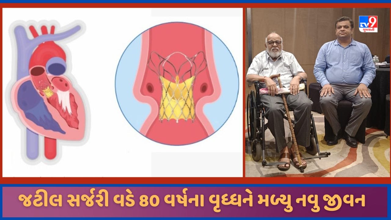 Ahmedabad ટ્રાન્સકેથેટર એઓર્ટિક વાલ્વ ઈમ્પ્લાન્ટેશન પ્રક્રિયા વડે 80