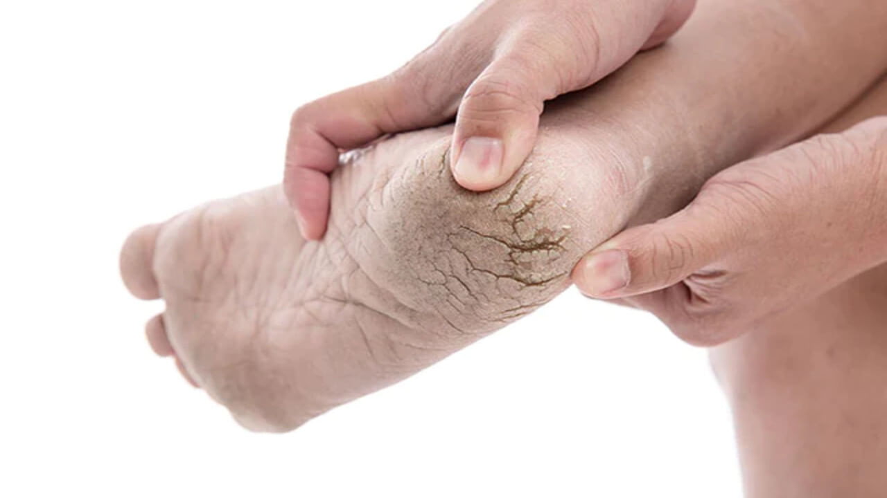 ડેડ ત્વચાના કોષોને દૂર કરવા અને તિરાડોને રોકવા માટે, અઠવાડિયામાં થોડી વાર હળવા પગની સ્ક્રબ અથવા પ્યુમિસ સ્ટોનનો ઉપયોગ કરો. તેને વધુ પડતું ન કરવાની કાળજી રાખો, કારણ કે વધુ પડતું ઘસવું પરિસ્થિતિને વધુ ખરાબ કરી શકે છે. હીલમાં પર ધ્યાન આપો, અને પછી moisturize ચકાસણી કરો.