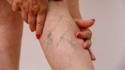 વેરિકોઝ વેન્સનાં લક્ષણો: ટાઈટ જીન્સ પહેરવાથી થઈ શકે છે નસોની આ ખતરનાક બીમારી, જાણો લક્ષણો અને બચાવની રીત