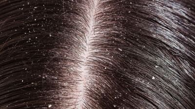 સ્કૈલ્પ ઉપરની ચામડી પર થયેલો ખોડો ઝડપથી દૂર થતો નથી. માથા પર બરફની જેમ ડેન્ડ્રફ દેખાય છે એટલું જ નહીં, તે ક્યારેક ખભા પર પણ પડે છે. આવી સ્થિતિમાં વ્યક્તિએ બીજાની સામે શરમનો શિકાર બનવું પડે છે. પરંતુ ડેન્ડ્રફ દૂર કરવું એ બહુ મુશ્કેલ કામ નથી. જો કેટલીક ઘરગથ્થુ વસ્તુઓનો ઉપયોગ કરવામાં આવે તો ડેન્ડ્રફ ઓછો થવા લાગે છે