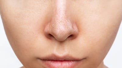 જ્યારે મેકઅપ, ગંદકી અને બેક્ટેરિયા ચહેરા પરના છિદ્રોમાં ભરાઈ જાય છે, ત્યારે બ્લેકહેડ્સની સમસ્યા થાય છે. જ્યારે તેઓ હવાના સંપર્કમાં આવે છે ત્યારે તે કાળા થઈ જાય છે, જેના કારણે ત્વચાનું તેજ ઓછું થઈ જાય છે અને ચહેરાની સુંદરતામાં ઘટાડો થાય છે. પરંતુ તમે ગમે તેટલી કોશિશ કરી લઈએ તેનાથી છૂટકારો મેળવવો આસાન નથી. ખરેખર, બ્લેકહેડ્સ નાક પર વધારે જોવા મળે છે. લોકો તેને દૂર કરવા માટે ઘણી બ્યુટી પ્રોડક્ટ્સનો ઉપયોગ કરે છે, પરંતુ તે પણ એટલા અસરકારક સાબિત થતા નથી.
