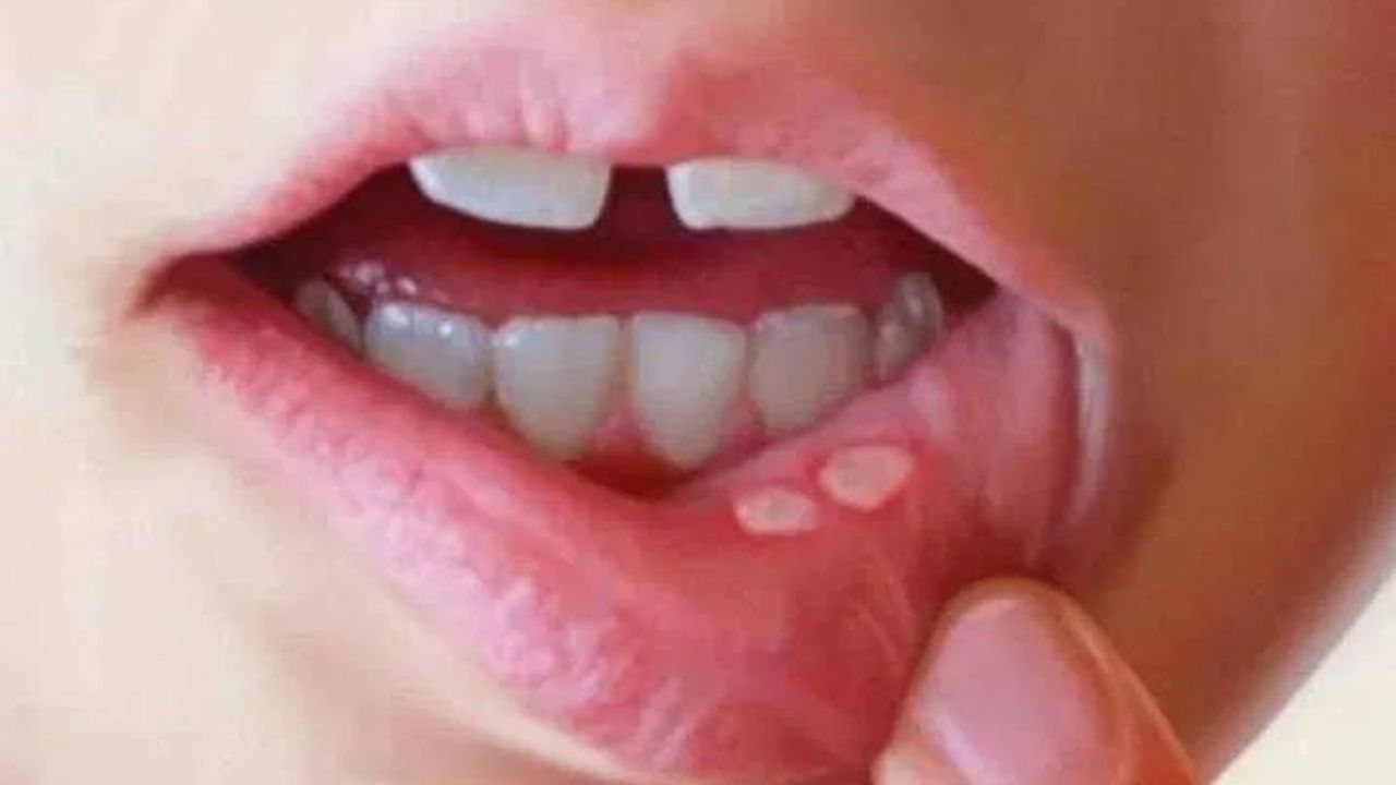 મોઢામાં ચાંદા : તમારા મોંમાં ચાંદા પડવા એ શરીરમાં આયર્નની ઉણપની નિશાની હોઈ શકે છે. તમે વિટામિન્સ બીના અપૂરતા સેવનને કારણે પણ થઈ શકે છે.
