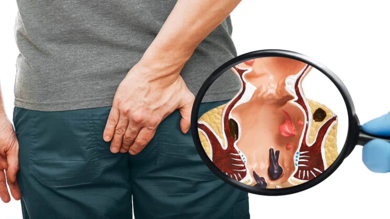 જો લાંબા સમય સુધી કબજિયાતની સારવાર ન કરવામાં આવે તો તે પાઈલ્સનું કારણ બની શકે છે. હેમોરહોઇડ્સ ગુદા માર્ગ પર મસાઓ અથવા ગઠ્ઠો જોવા મળી શકે છે. જો તમે આ સમસ્યાથી પરેશાન છો, તો આજે અમે તમને એક એવી શાકભાજી વિશે જણાવીશું જે તમારી સમસ્યાને તેના મૂળથી દૂર કરી શકે છે.